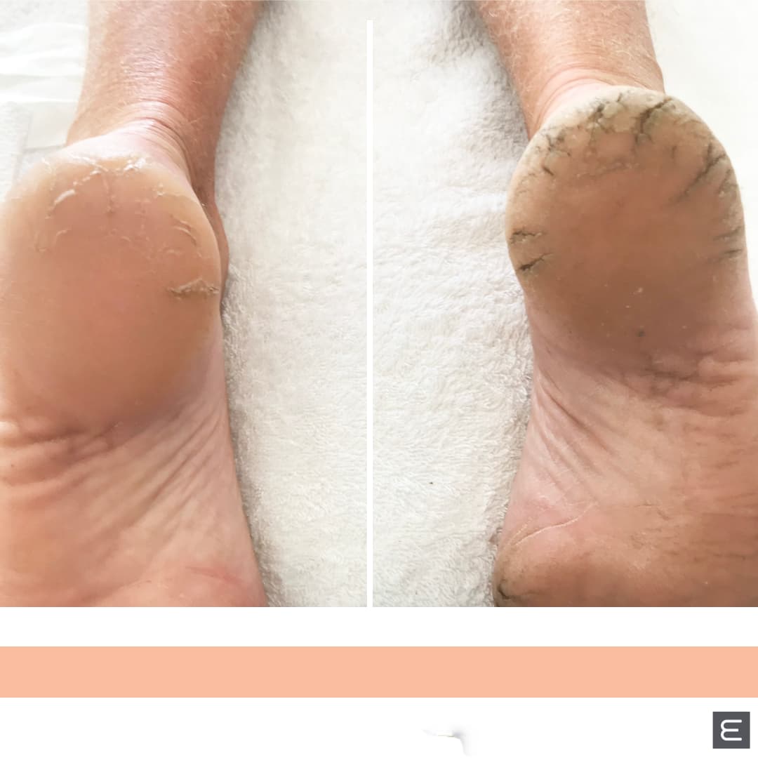MediHeel Before and After for Cracked Heels