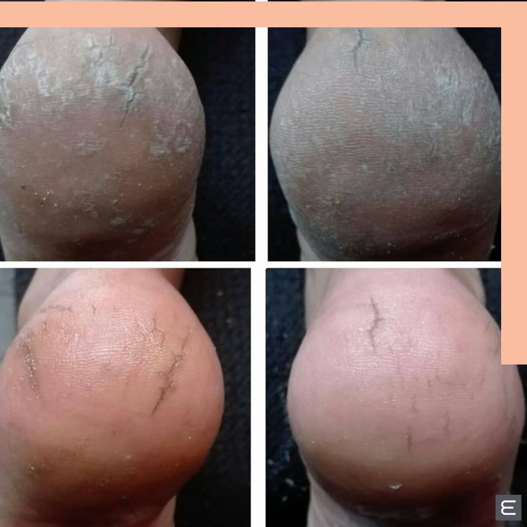 MediHeel for Dry Feet