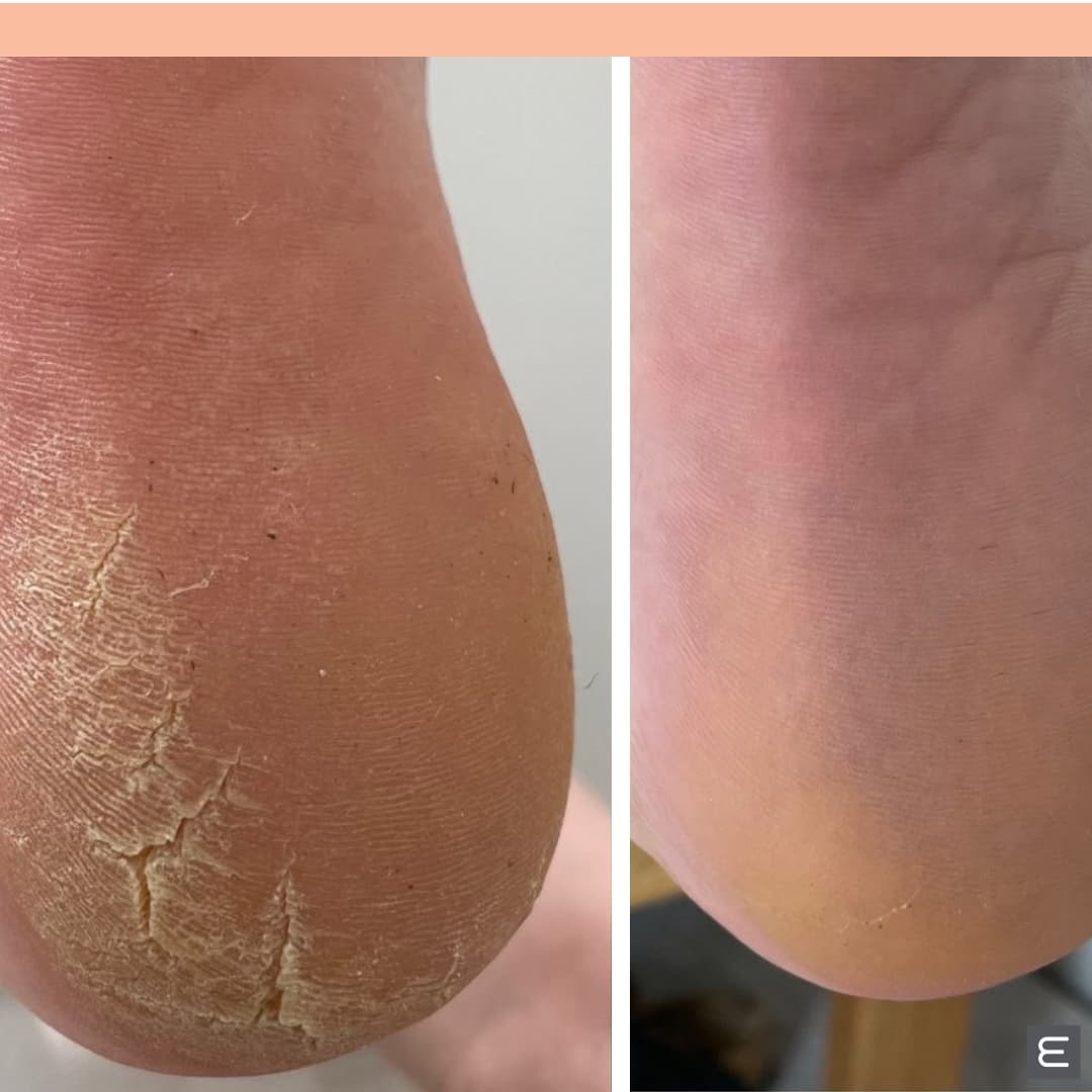 MediHeel Before and After Results
