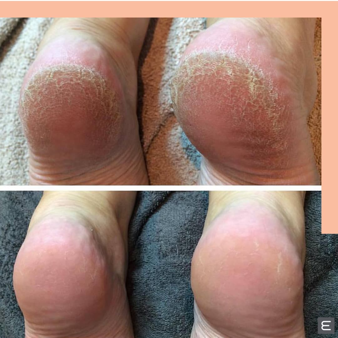MediHeel for Severely Cracked Heels