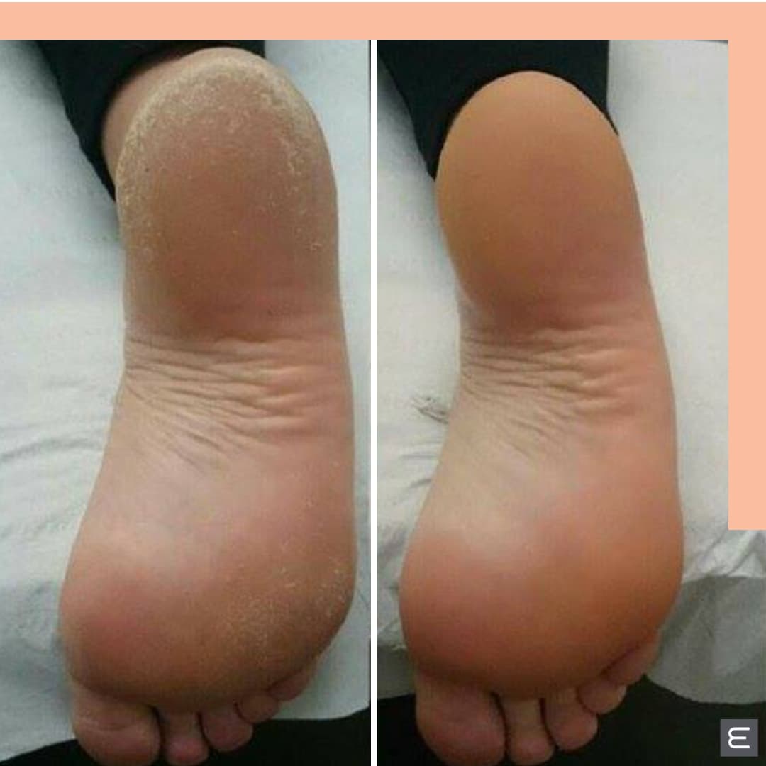 MediHeel Treatment for Dry Feet